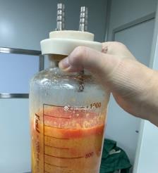 霍邱水动力吸脂手术要做多久？